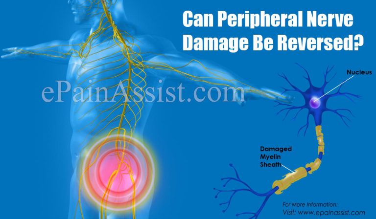 Can Peripheral Nerve Damage Be Reversed?