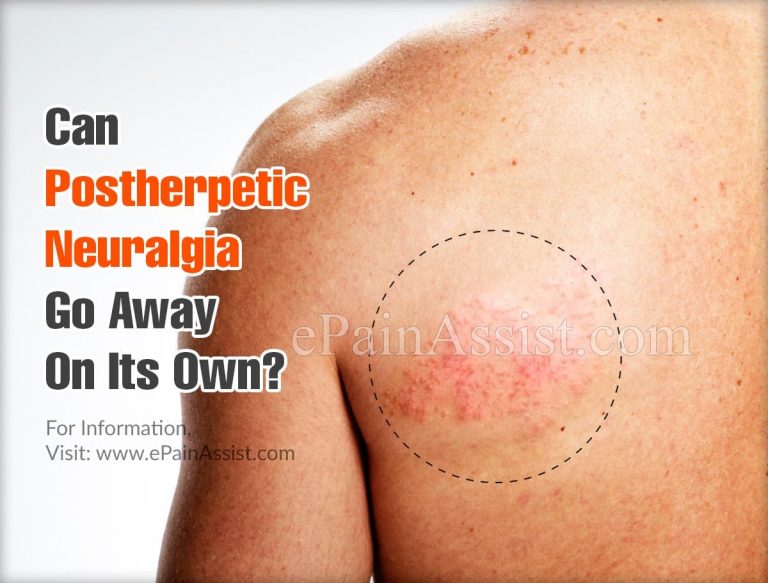 Can Postherpetic Neuralgia Go Away On Its Own & What Are It’s Natural Remedies?