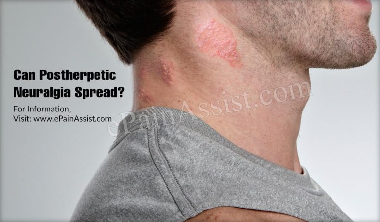 Can Postherpetic Neuralgia Spread & How Do You Stop It From Spreading?