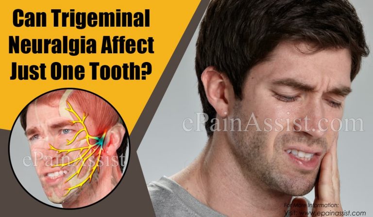 Can Trigeminal Neuralgia Affect Just One Tooth & Does It Cause Swelling?