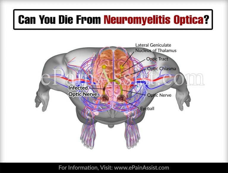 Can You Die From Neuromyelitis Optica?