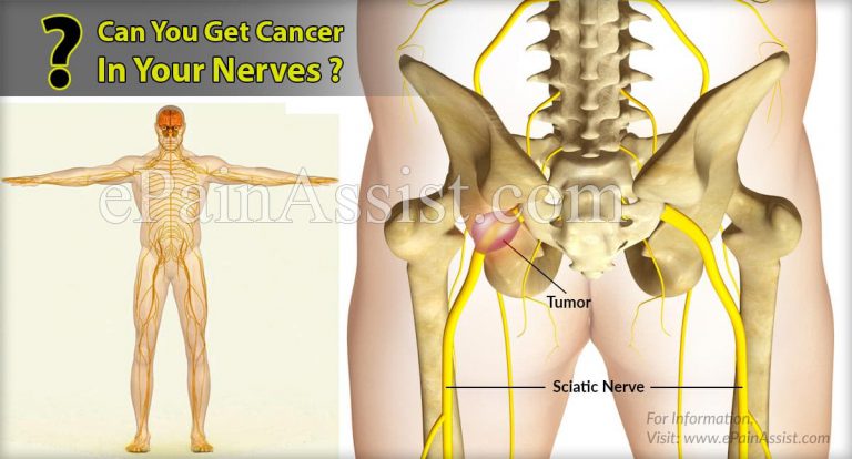 Can You Get Cancer In Your Nerves?
