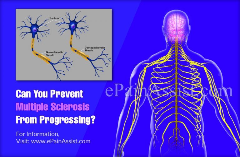 Can You Prevent Multiple Sclerosis From Progressing?
