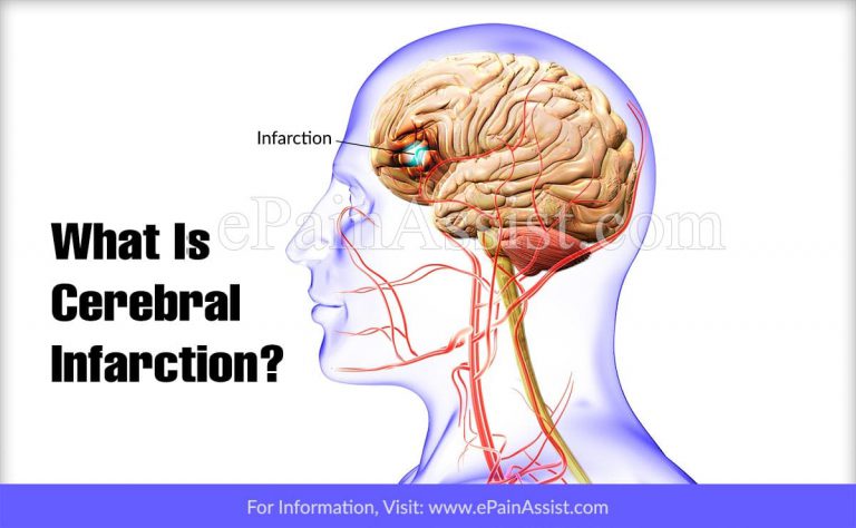 Cerebral Infarction: Types, Causes, Symptoms, Treatments