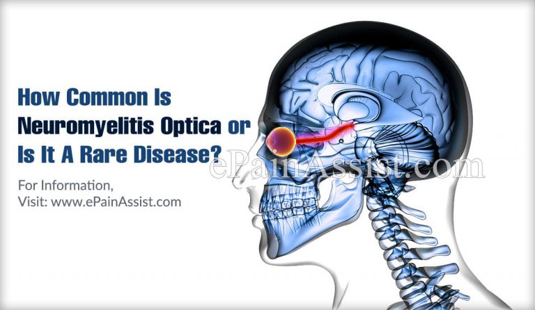 How Common Is Neuromyelitis Optica or Is It A Rare Disease?