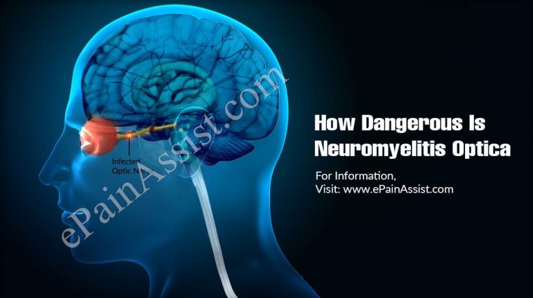 How Dangerous Is Neuromyelitis Optica & Is It Contagious?