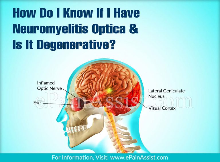 How Do I Know If I Have Neuromyelitis Optica & Is It Degenerative?
