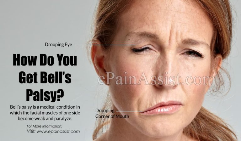 How Do You Get Bell’s Palsy & How Long Does It Take To Recover From Bell’s Palsy?