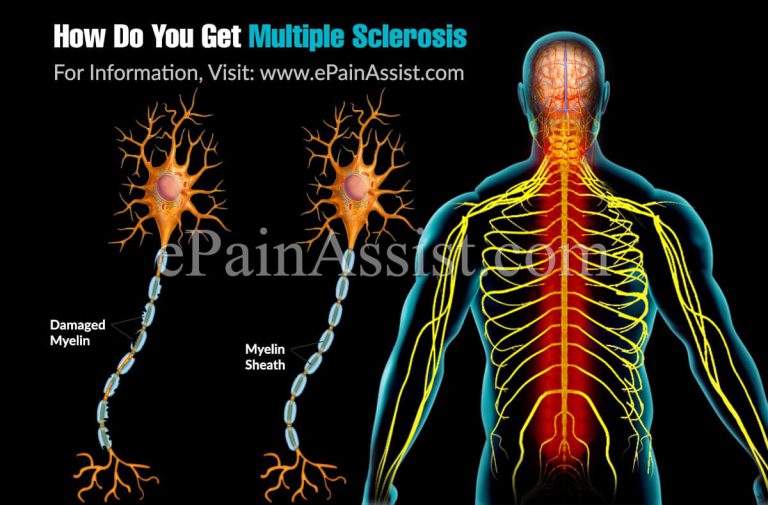 How Do You Get Multiple Sclerosis?