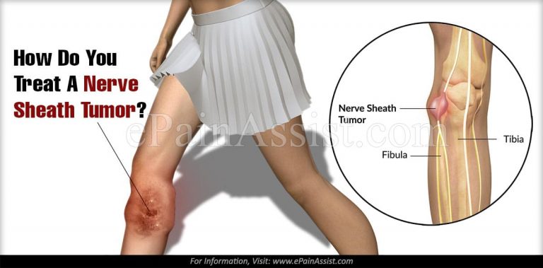 How Do You Treat A Nerve Sheath Tumor?