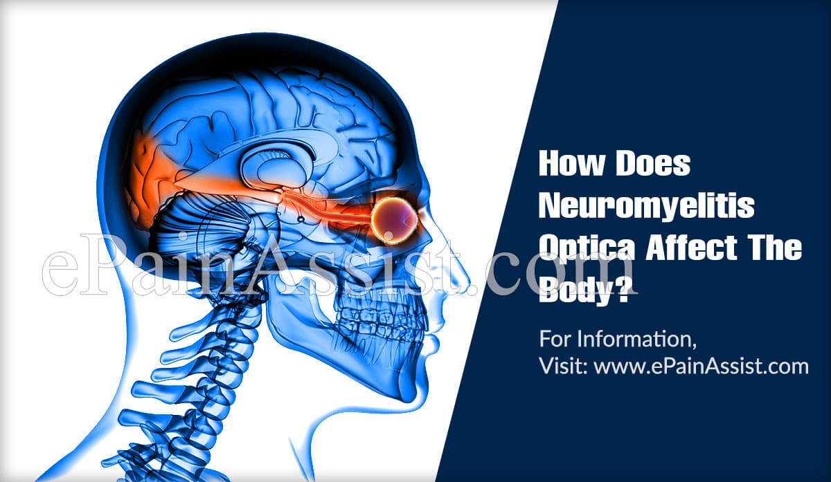 How Does Neuromyelitis Optica Affect The Body?