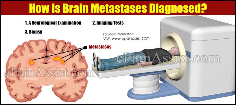 How Is Brain Metastases Diagnosed?