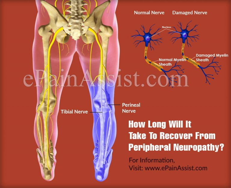 How Long Will It Take To Recover From Peripheral Neuropathy & How Long Does The Symptoms Last?
