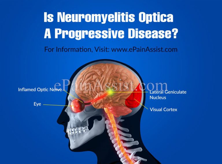 Is Neuromyelitis Optica A Progressive Disease & Alternative Treatments For It