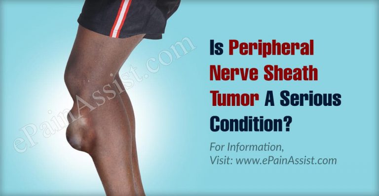 Is Peripheral Nerve Sheath Tumor A Serious Condition?