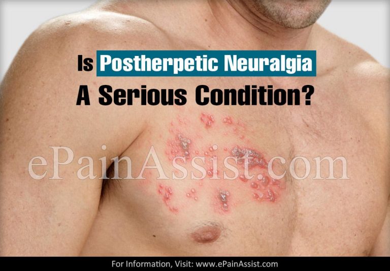Is Postherpetic Neuralgia A Serious Condition & Can It Be Reversed?