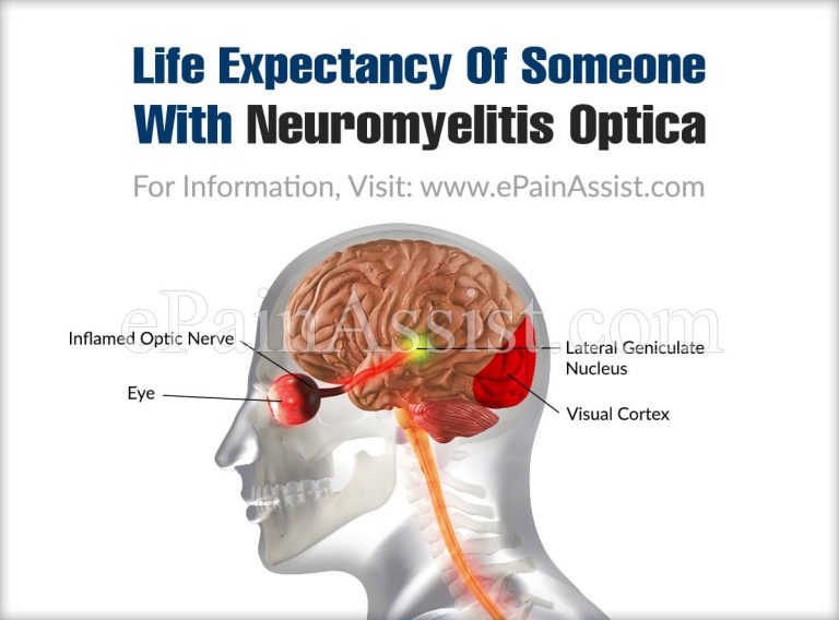 Life Expectancy Of Someone With Neuromyelitis Optica