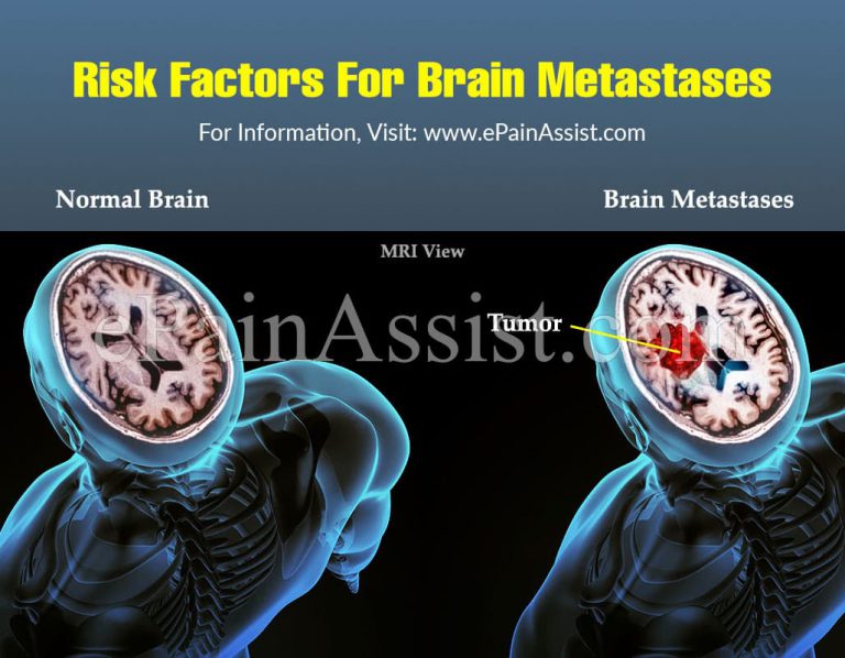 Risk Factors For Brain Metastases