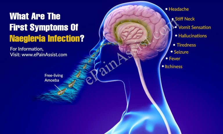 What Are The First Symptoms Of Naegleria Infection?