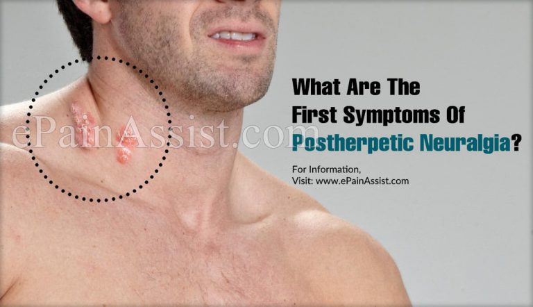 What Are The First Symptoms Of Postherpetic Neuralgia & How Do You Test For It?