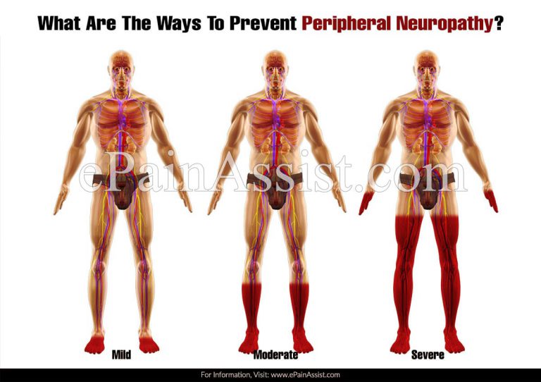 What Are The Ways To Prevent Peripheral Neuropathy & Does It Reoccur?
