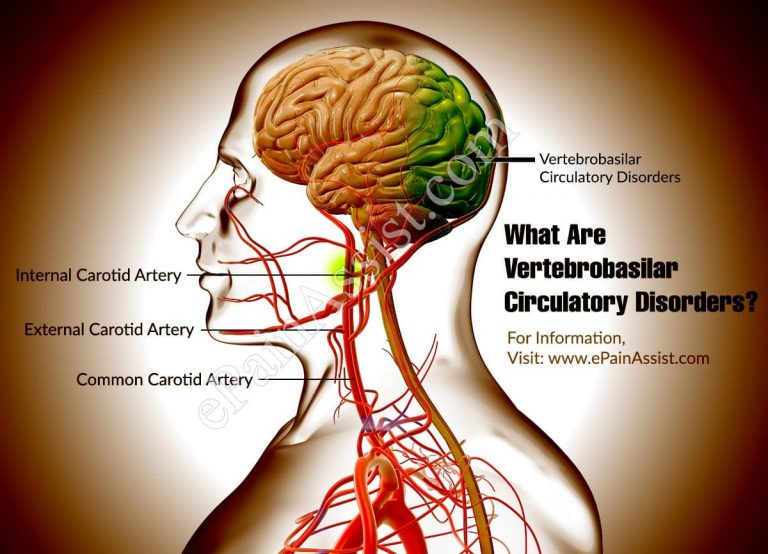 What is Vertebrobasilar Circulatory Disorders & How is it Treated?| Causes, Symptoms, Diagnosis of Vertebrobasilar Circulatory Disorders