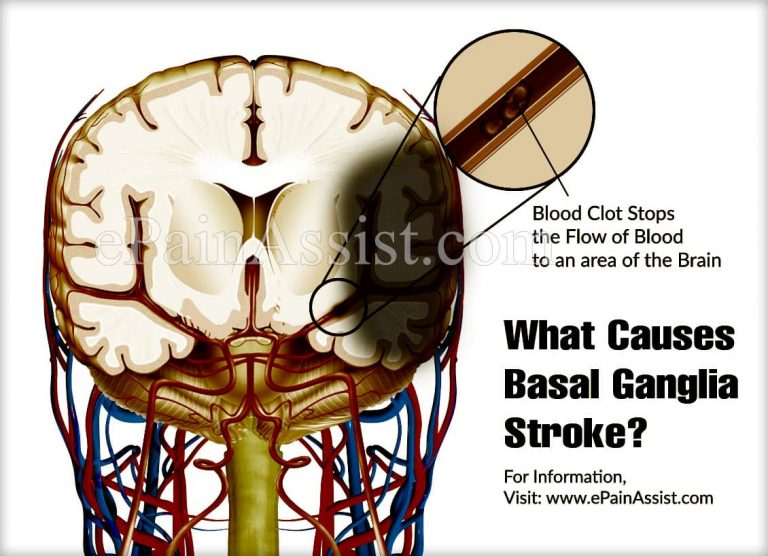 What is Basal Ganglia Stroke, Know its Causes & Treatment