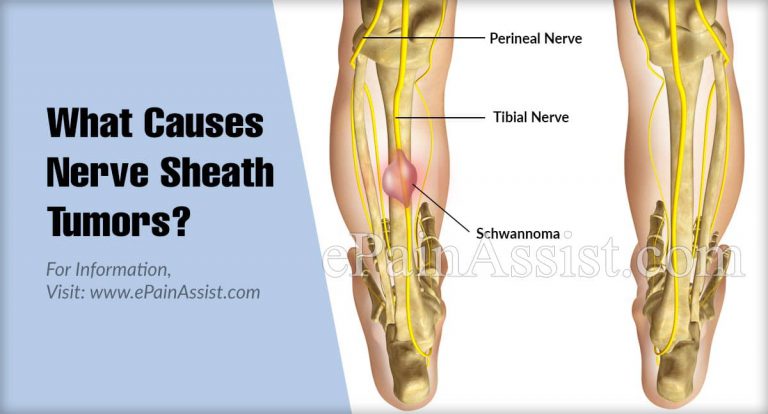 What Causes Nerve Sheath Tumors?
