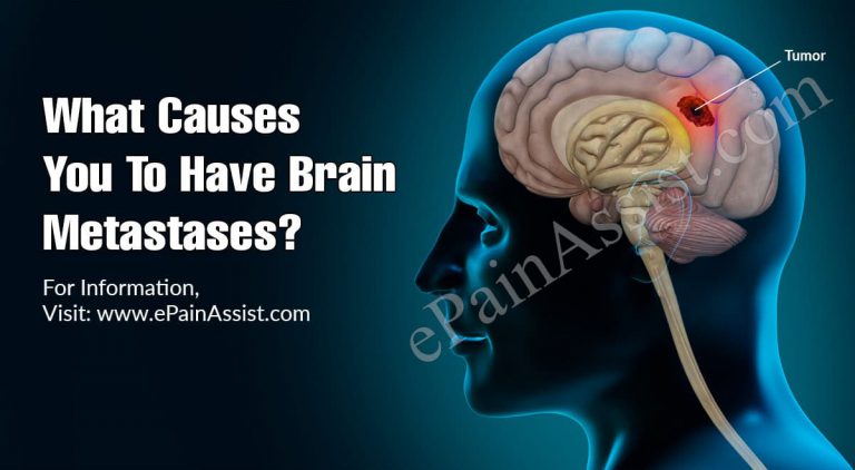 What Causes You To Have Brain Metastases?