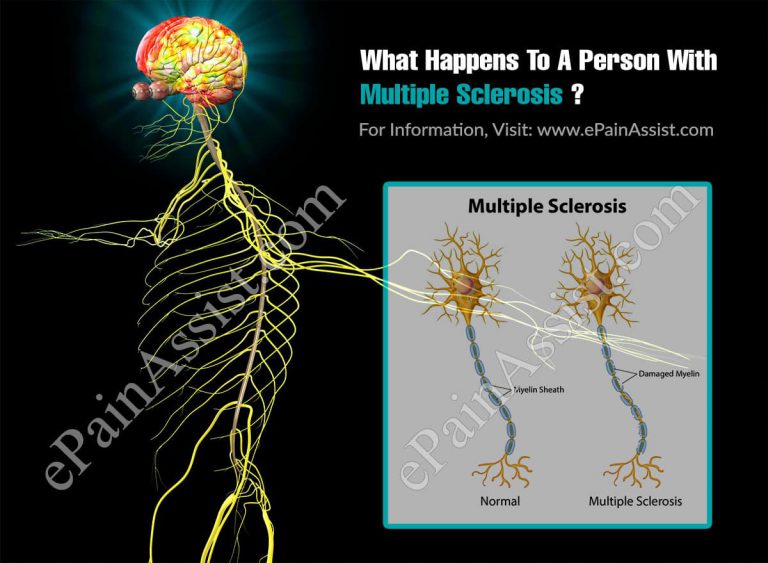 What Happens To A Person With Multiple Sclerosis?