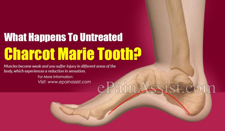 What Happens To Untreated Charcot Marie Tooth & When To Go To Doctor?