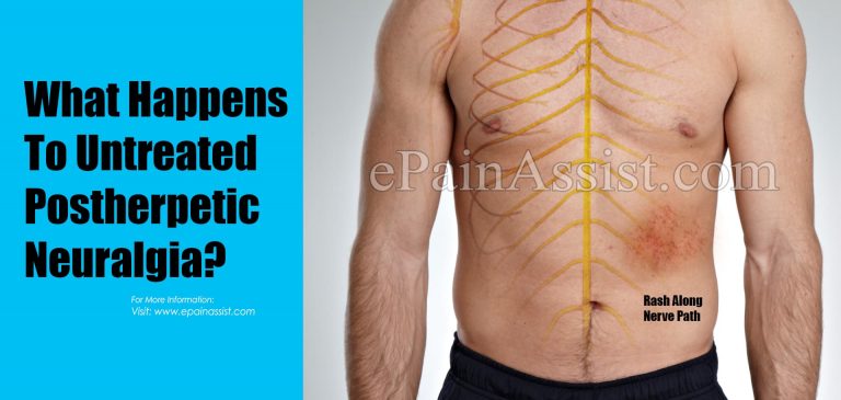 What Happens To Untreated Postherpetic Neuralgia & When To Go To Doctor?