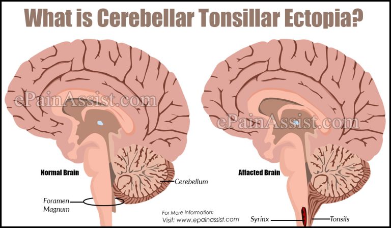 What is Cerebellar Tonsillar Ectopia?: Symptoms, Causes, Diagnosis, Treatment