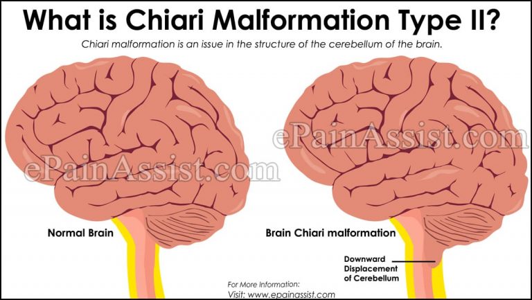 What is Chiari Malformation Type II, How Does it Affect Your Body and What is its Treatment?
