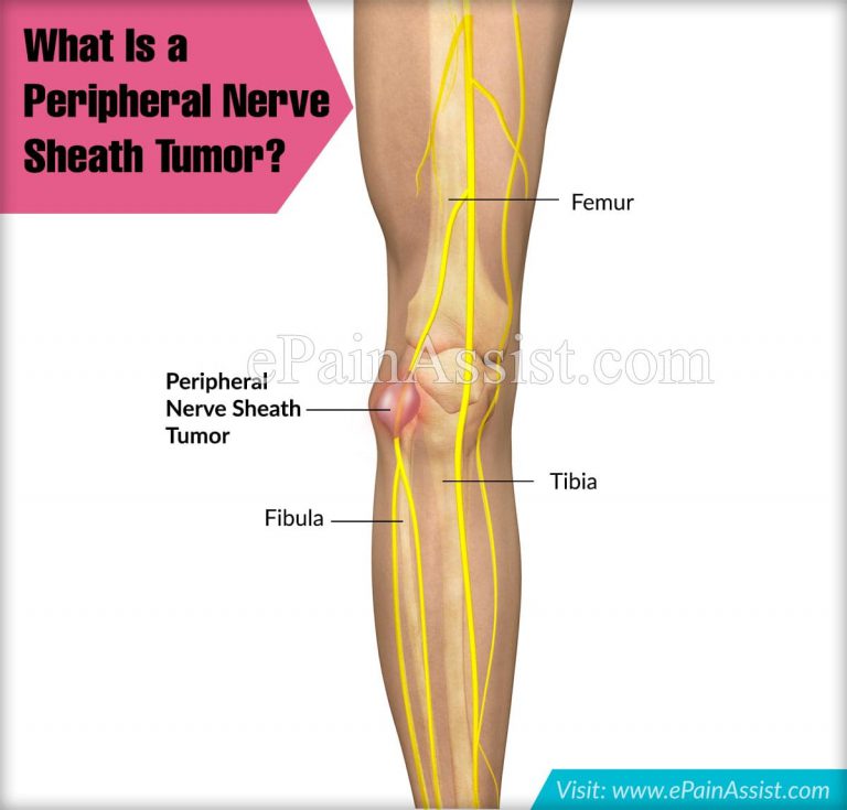 What Is A Peripheral Nerve Sheath Tumor?