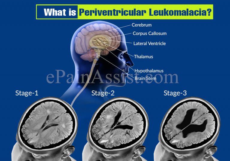 What is Periventricular Leukomalacia? Causes, Symptoms, Treatment, Prognosis, Prevalence, Prevention