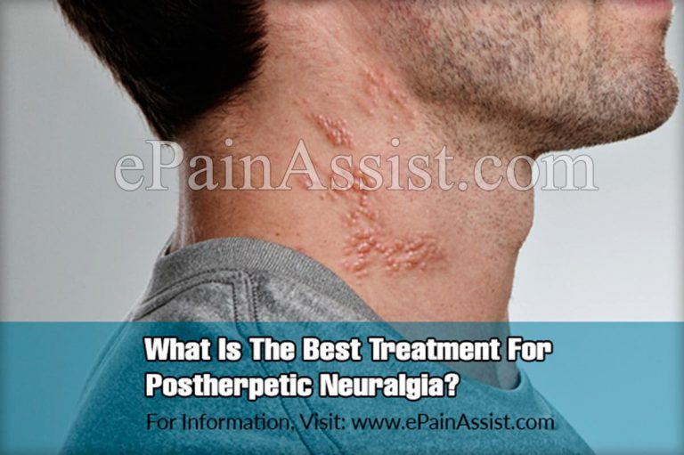 What Is The Best Treatment For Postherpetic Neuralgia?