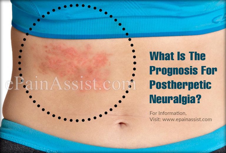 What Is The Prognosis For Postherpetic Neuralgia?
