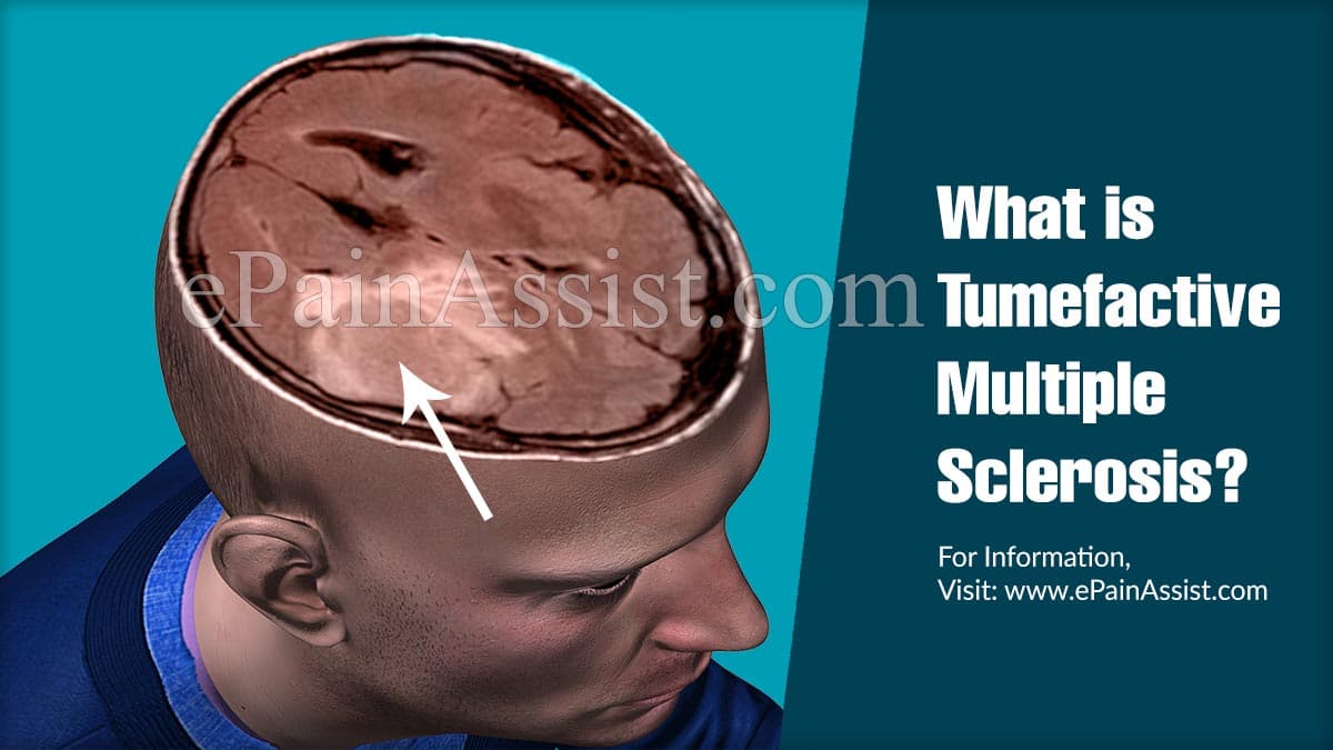 What is Tumefactive Multiple Sclerosis?