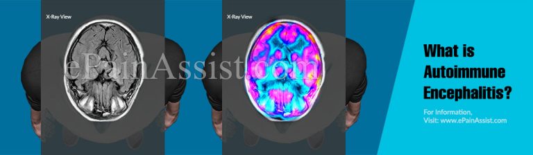 Autoimmune Encephalitis After Herpes Simplex Encephalitis: Frequency, Symptoms, Risk Factors and Outcomes