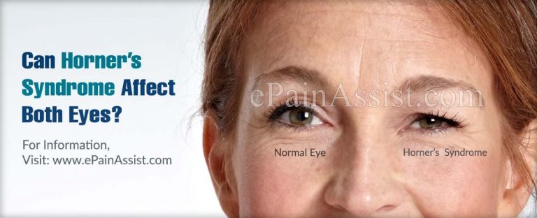 Can Horner’s Syndrome Affect Both Eyes & Can Diabetes Cause Horner’s Syndrome?