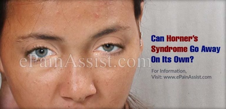 Can Horner’s Syndrome Go Away On Its Own & What Are Its Natural Remedies?