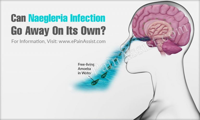 Can Naegleria Infection Go Away On Its Own?