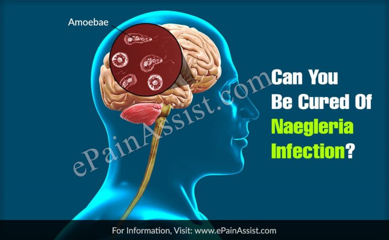 Can You Be Cured Of Naegleria Infection?
