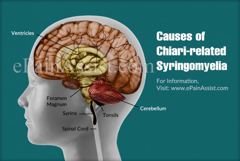 Chiari-related Syringomyelia: Causes, Symptoms, Treatment, Diagnosis