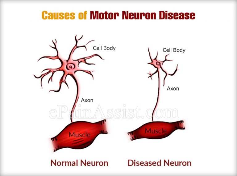 Motor Neuron Diseases: Causes, Types, Symptoms, Signs, Treatment, Diagnosis
