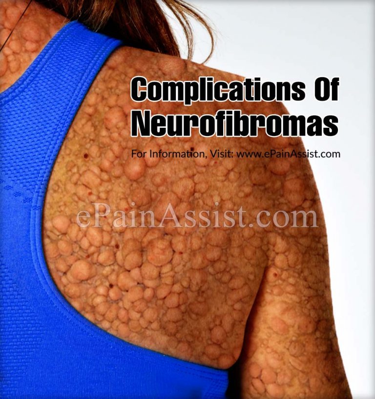 Complications Of Neurofibromas & How Do You Evaluate It?