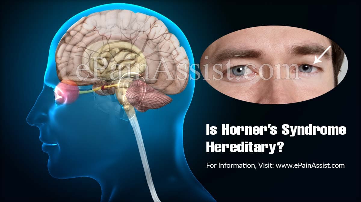 Is Horner's Syndrome Hereditary?