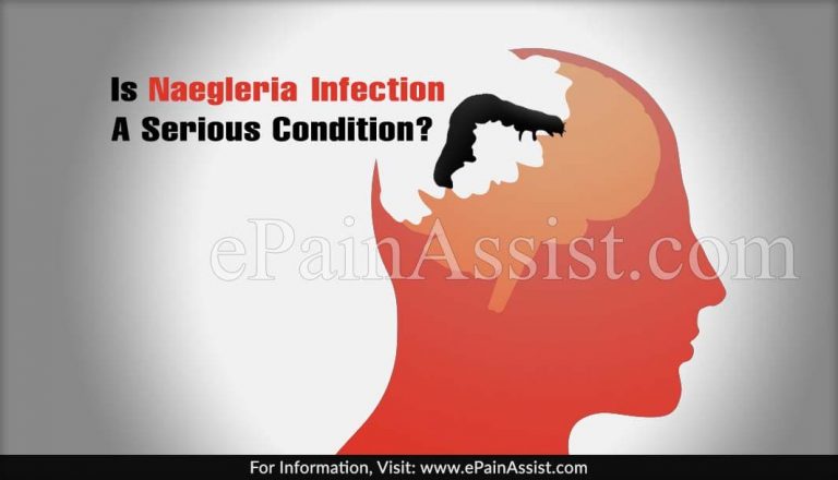 Is Naegleria Infection A Serious Condition?