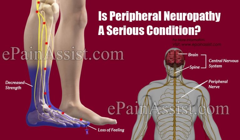 Is Peripheral Neuropathy A Serious Condition & Can It Be Reversed?